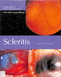 fundamentals of clinical ophthalmology ,scleritis